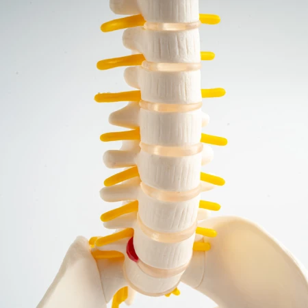 Disc Herniation Treatment and Bulging Disc Relief in Surf City